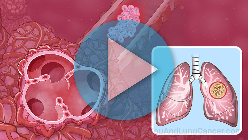 Animation - Understanding Non-Small Cell Lung Cancer