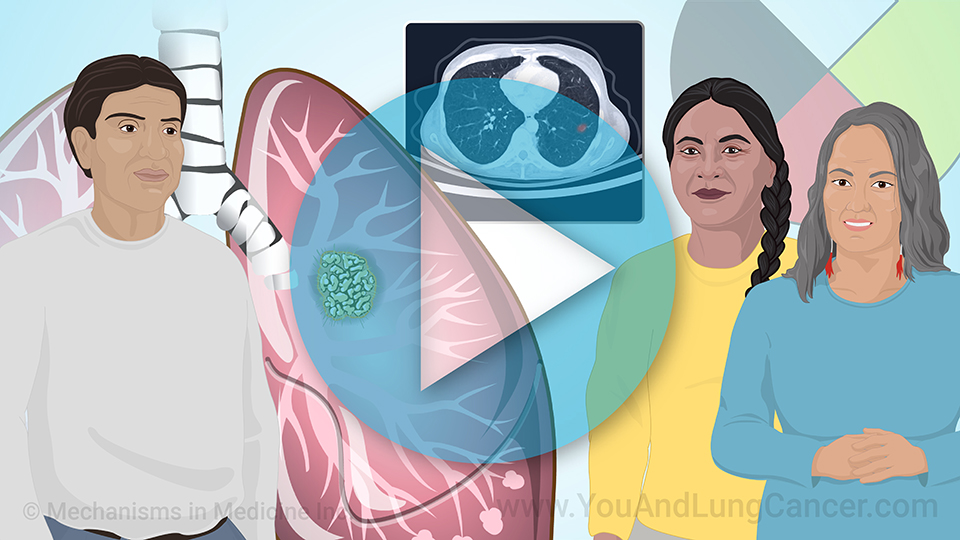 Animation - Early Detection and Screening for Lung Cancer in Native Americans