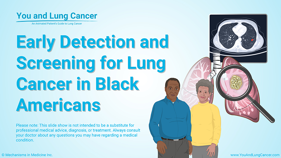 Slide Show - Early Detection and Screening for Lung Cancer in Black Americans