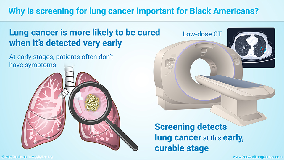 Why is screening for lung cancer important for Black Americans? 