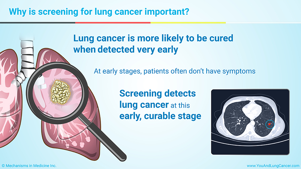 Why is screening for lung cancer important?