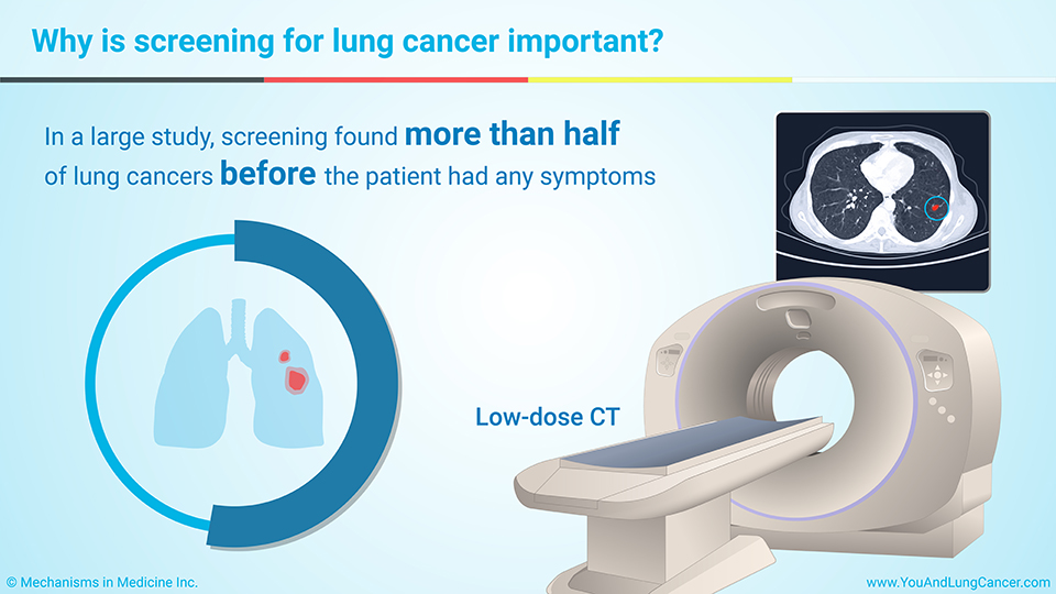 Why is screening for lung cancer important?