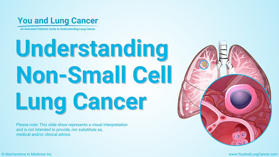 Slide Show Understanding NonSmall Cell Lung Cancer