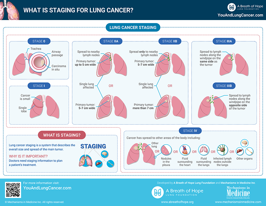 Staging Of Lung Cancer Chart