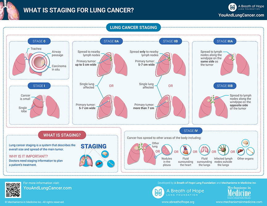 Lung Cancer TNM Staging Chart