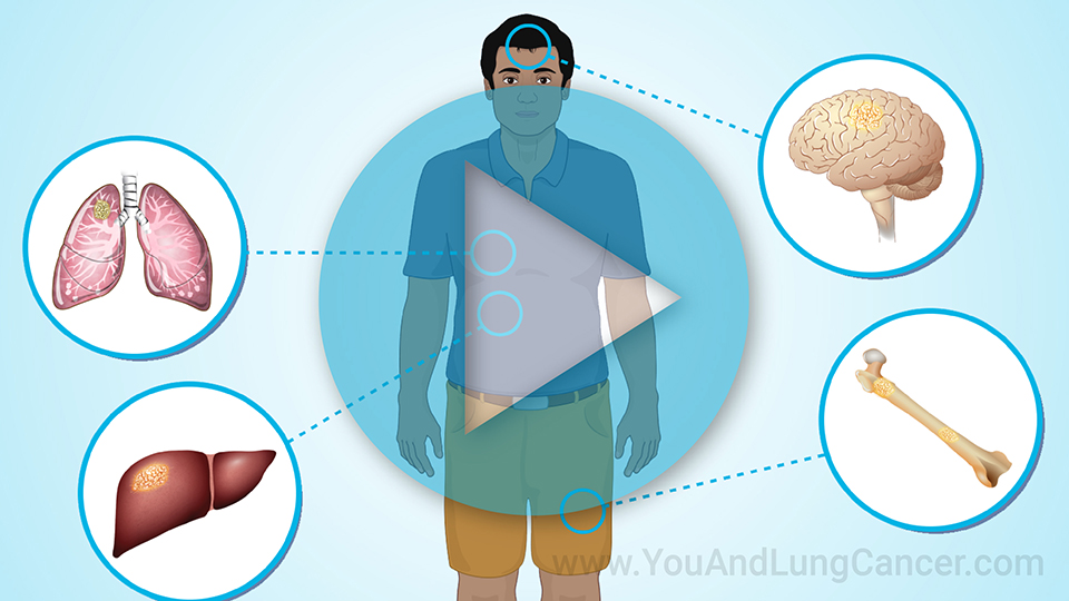 Understanding Small Cell Lung Cancer