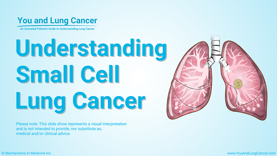 Slide Show - Understanding Small Cell Lung Cancer