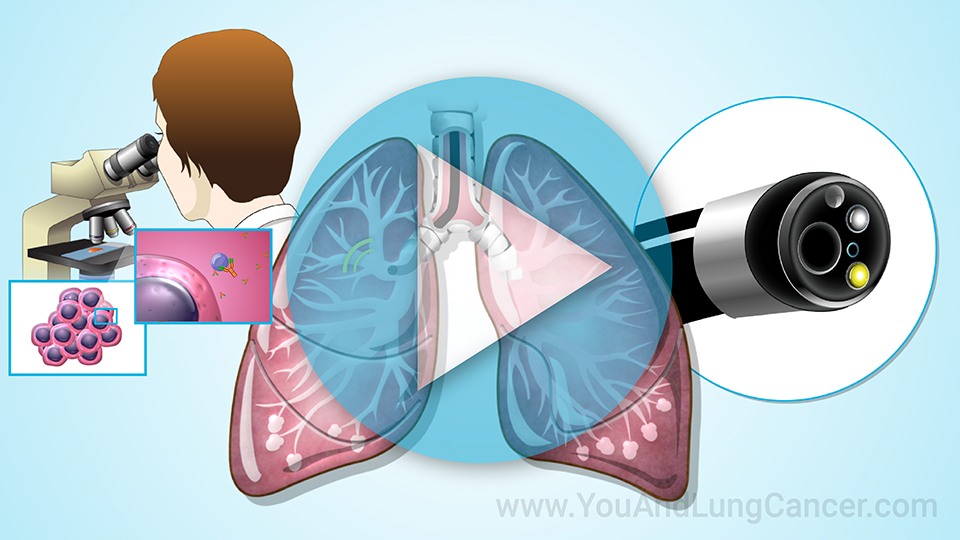 Animation - Diagnosis and Screening of Lung Cancer
