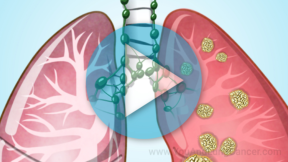 Animation - Staging of Lung Cancer