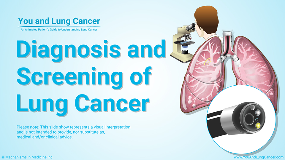 Slide Show - Diagnosis and Screening of Lung Cancer