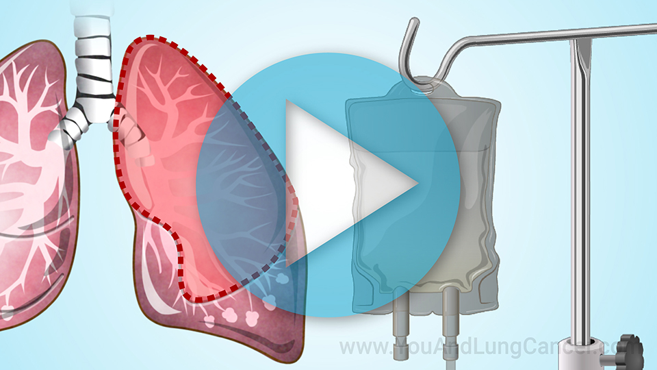 Animation - Treatment and Management of SCLC