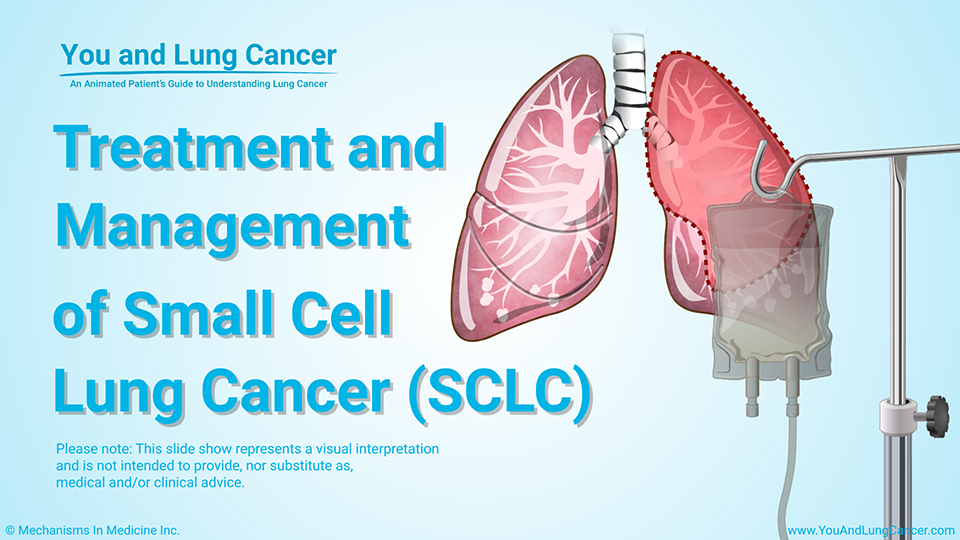 Treatment and Management of Small Cell Lung Cancer (SCLC)