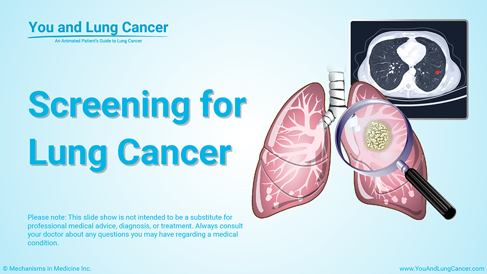 Screening for Lung Cancer