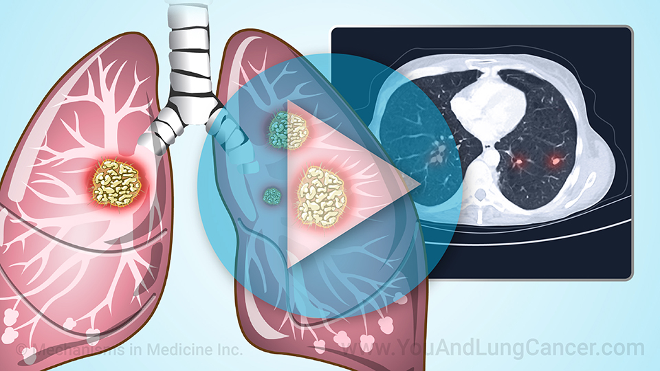 Animation - Screening for Lung Cancer