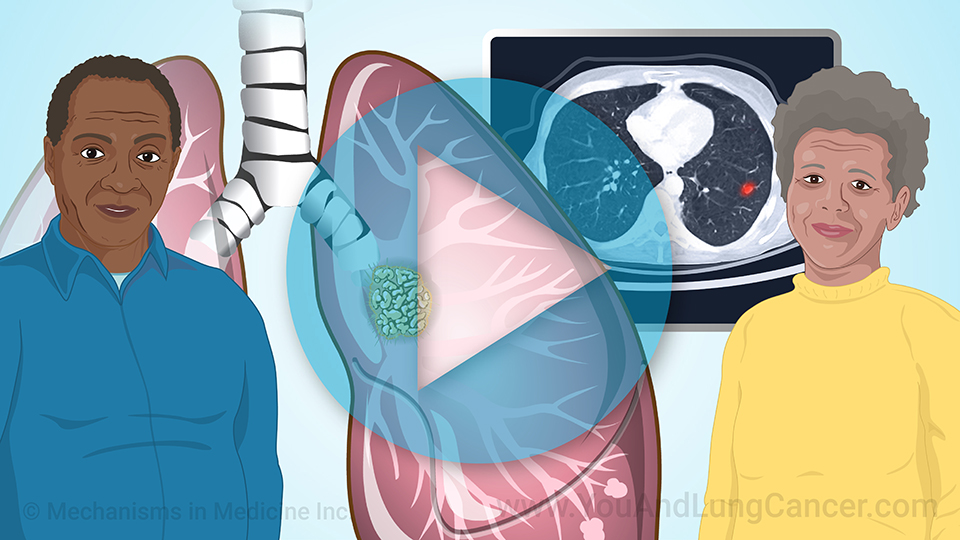 Lung Cancer Screening for Black Americans