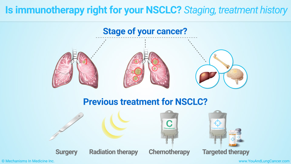 Is immunotherapy right for your NSCLC? Staging, treatment history