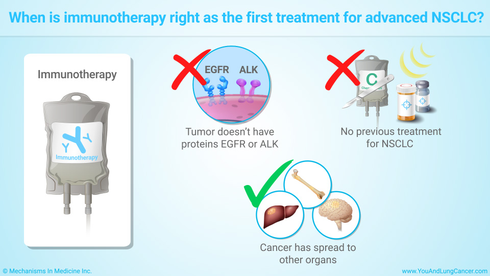 When is immunotherapy right as the first treatment for advanced NSCLC?