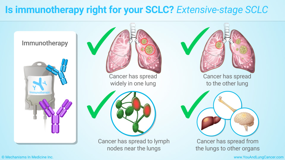 Is immunotherapy right for your SCLC? Extensive-stage SCLC