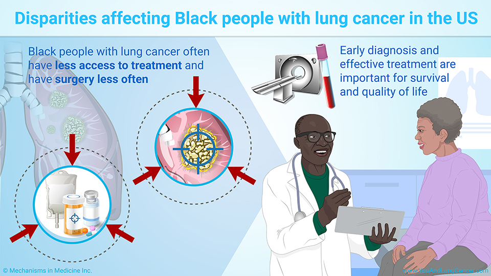 Disparities affecting Black people with lung cancer in the US