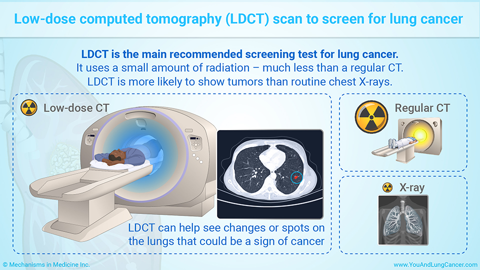 Low-dose computed tomography (LDCT) scan to screen for lung cancer