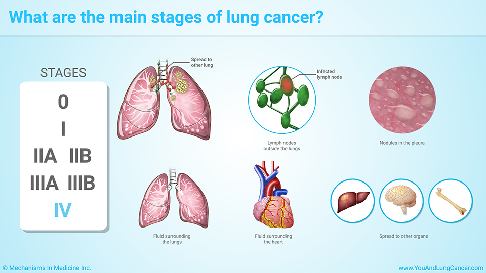 Slide Show - Staging of Lung Cancer