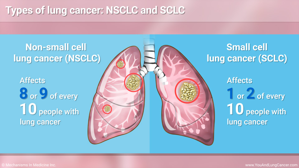 Types of lung cancer: NSCLC and SCLC