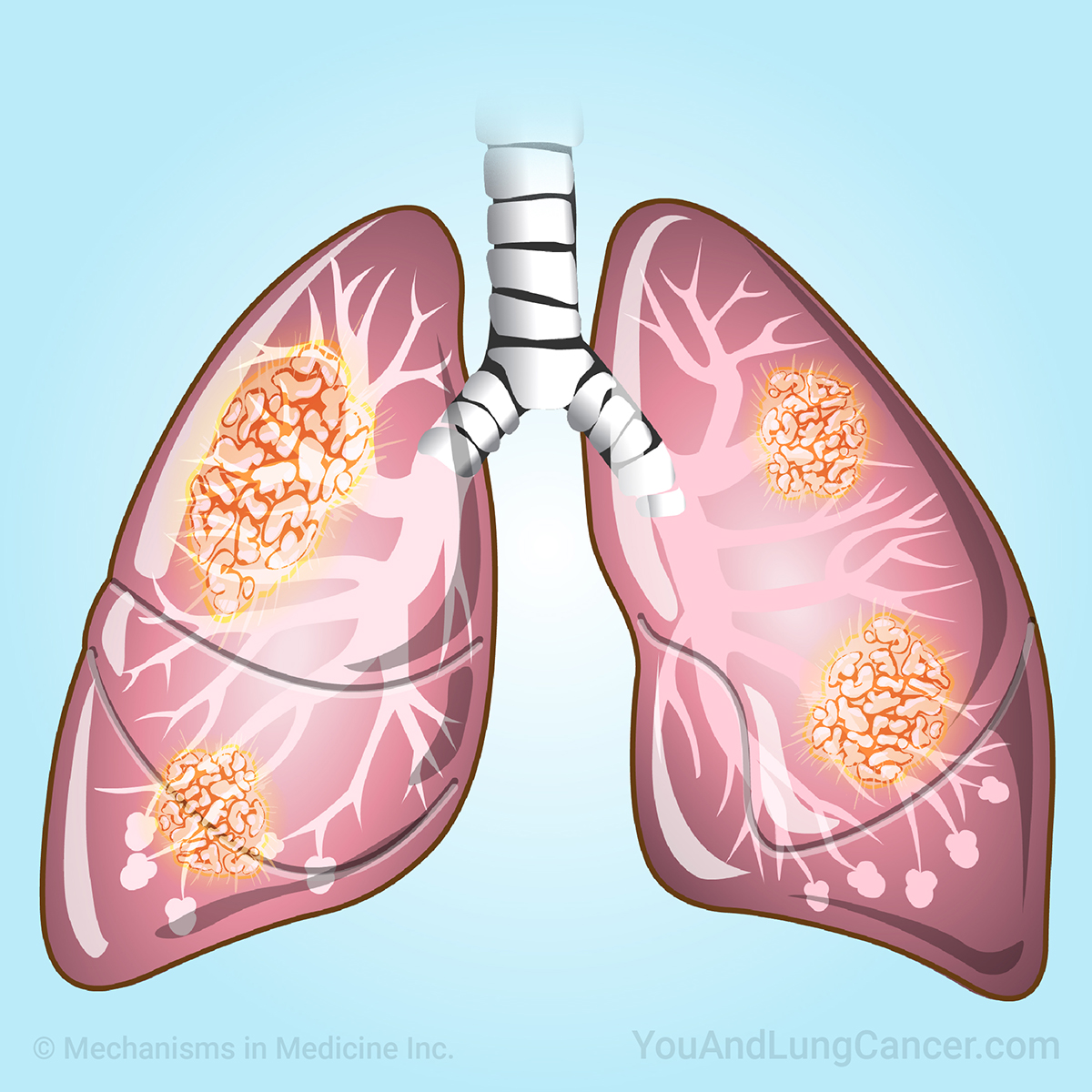 Learn about a variety of topics on lung cancer through short animations